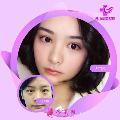 佛山華美整形美容醫(yī)院雙眼皮切口