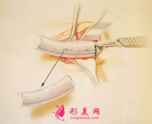 自體軟骨隆鼻后會鈣化嗎？