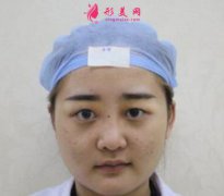 北京大學(xué)人民醫(yī)院整形科雙眼皮效果曝光!前后對(duì)比效果很自然