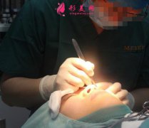 上海伯思立徐曉菲雙眼皮案例怎么樣?醫(yī)生手術(shù)恢復(fù)效果一覽