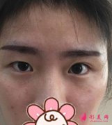廣州南方醫(yī)院整形科怎么樣？馮傳波醫(yī)生雙眼皮案例來了！