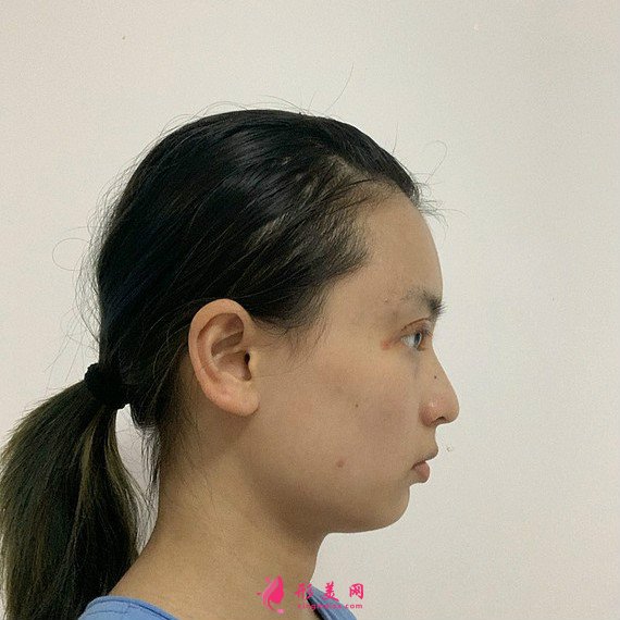 切開雙眼皮和開內(nèi)眼角 切開雙眼皮和開內(nèi)眼角