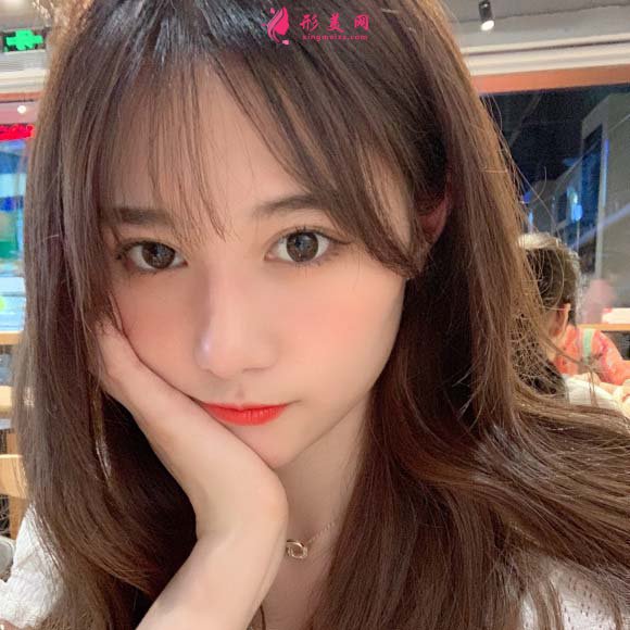 面部脂肪填充手術(shù)真實(shí)恢復(fù)過程，記錄美好生活