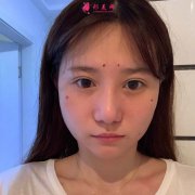 面部脂肪填充手術(shù)真實恢復(fù)過程，記錄美好生活