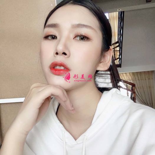 做完超皮秒祛斑效果是超級好 做完超皮秒祛斑效果是超級好