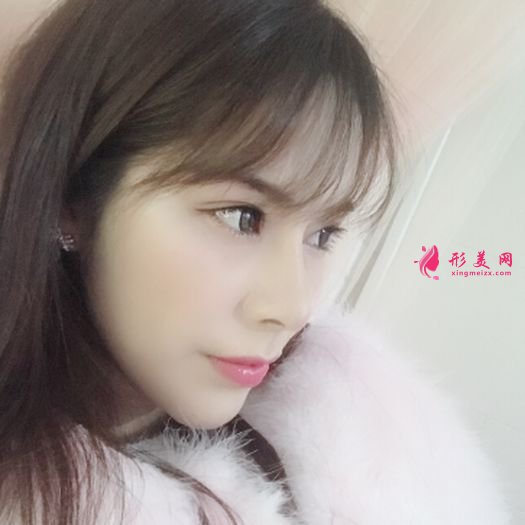 肋軟骨鼻綜合之后自拍美美噠 肋軟骨鼻綜合之后自拍美美噠