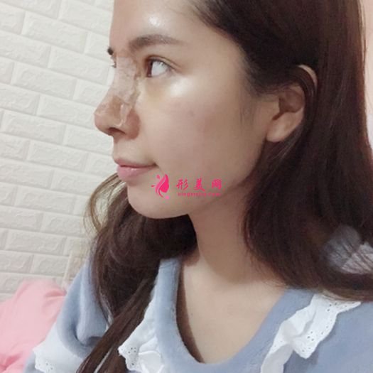 肋軟骨鼻綜合之后自拍美美噠 肋軟骨鼻綜合之后自拍美美噠