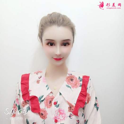 天津眼部綜合+肋軟骨鼻綜合案列分享 天津眼部綜合+肋軟骨鼻綜合案列分享