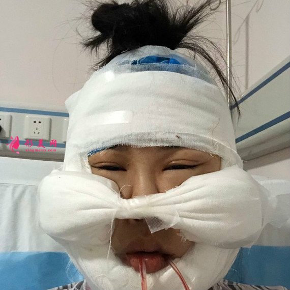 廣州下頜角整形+顴骨顴弓降低+咬肌縮小手術(shù)過(guò)程恢復(fù)分享 廣州下頜角整形+顴骨顴弓降低+咬肌縮小手術(shù)過(guò)程恢復(fù)分享