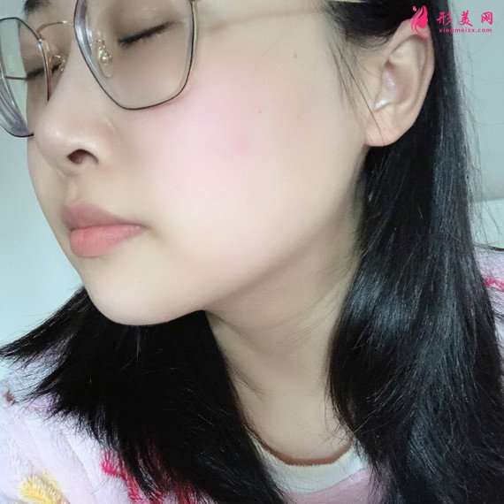 廣州下頜角整形+顴骨顴弓降低+咬肌縮小手術(shù)過(guò)程恢復(fù)分享 廣州下頜角整形+顴骨顴弓降低+咬肌縮小手術(shù)過(guò)程恢復(fù)分享