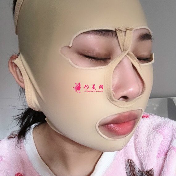 廣州下頜角整形+顴骨顴弓降低+咬肌縮小手術(shù)過(guò)程恢復(fù)分享 廣州下頜角整形+顴骨顴弓降低+咬肌縮小手術(shù)過(guò)程恢復(fù)分享