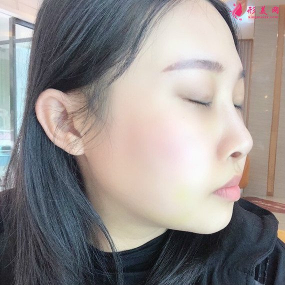 廣州下頜角整形+顴骨顴弓降低+咬肌縮小手術(shù)過(guò)程恢復(fù)分享 廣州下頜角整形+顴骨顴弓降低+咬肌縮小手術(shù)過(guò)程恢復(fù)分享