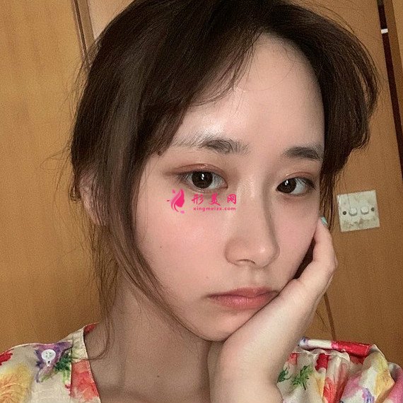 全切雙眼皮恢復(fù)的速度很快，就算是素顏也很美！