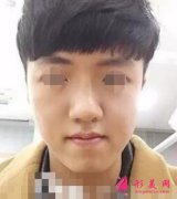 北京八大處整形醫(yī)院削骨怎么樣？手術(shù)后恢復(fù)男生也能錐子臉