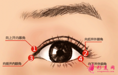 做開眼角后要多久恢復(fù)自然？