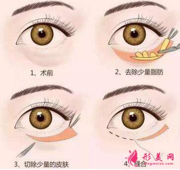 手術(shù)切除眼袋會(huì)失敗嗎