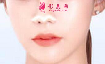 鼻翼縮小手術(shù)恢復(fù)期內(nèi)要注意什么