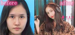 深圳麗港麗格醫(yī)療美容肋軟骨隆鼻_謝俊醫(yī)生|案例分享