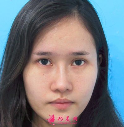 深圳麗港麗格醫(yī)療美容肋軟骨隆鼻
