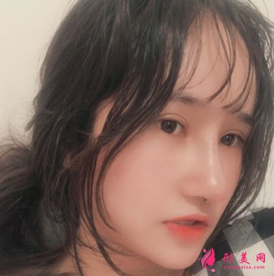 深圳麗港麗格醫(yī)療美容肋軟骨隆鼻