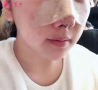 寧波壹加壹整形醫(yī)院，郭光燁醫(yī)生鼻整形案例分享