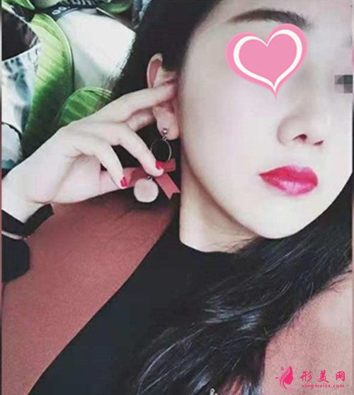 寧波郭光燁隆鼻多久能恢復 寧波郭光燁隆鼻多久能恢復
