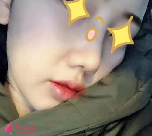 寧波壹加壹整形隆鼻真實案例 寧波壹加壹整形隆鼻真實案例