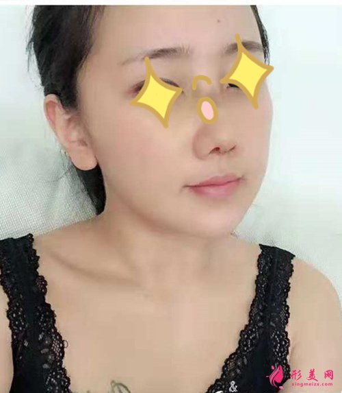 寧波假體隆鼻術后一周實拍 寧波假體隆鼻術后一周實拍