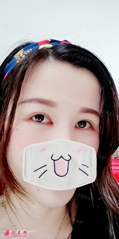 雙眼皮開眼角術(shù)后40天 雙眼皮開眼角術(shù)后40天