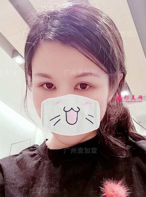 雙眼皮術(shù)后15天 雙眼皮術(shù)后15天