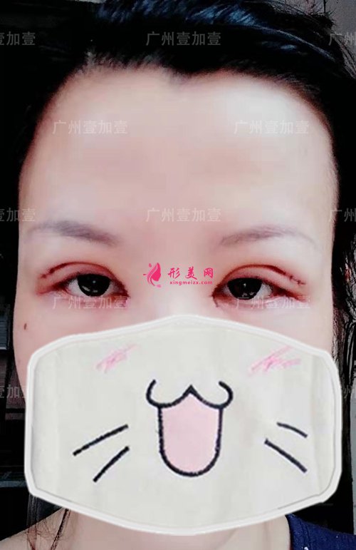 雙眼皮術(shù)后第二天 雙眼皮術(shù)后第二天