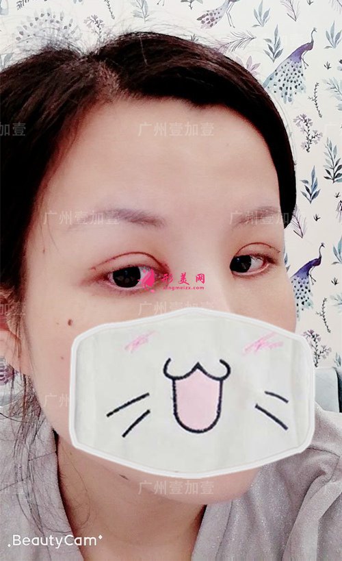 雙眼皮開眼角術(shù)后一周 雙眼皮開眼角術(shù)后一周