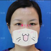 廣州壹加壹整形醫(yī)院雙眼皮+開(kāi)內(nèi)眼角手術(shù)案列分享