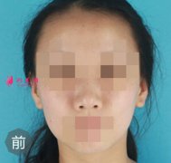 上海玫瑰美容整形醫(yī)院綜合隆鼻前后對(duì)比圖