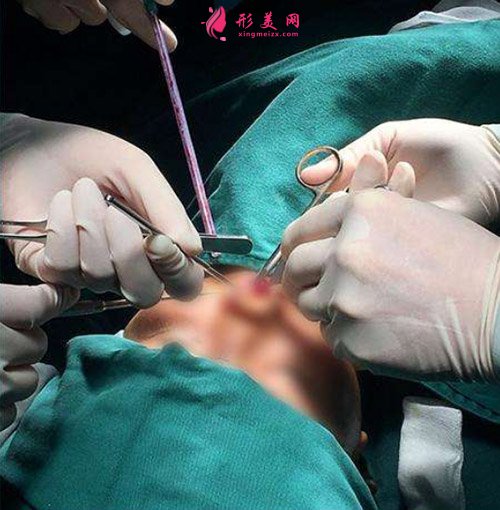 鼻綜合手術(shù)正在進(jìn)行 鼻綜合手術(shù)正在進(jìn)行