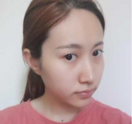 鄭州集美整形劉德輝做的雙眼皮效果圖來辣
