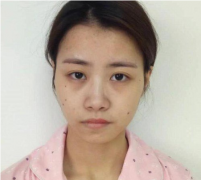 南京華美翟奔宇隆鼻術后恢復效果圖分享