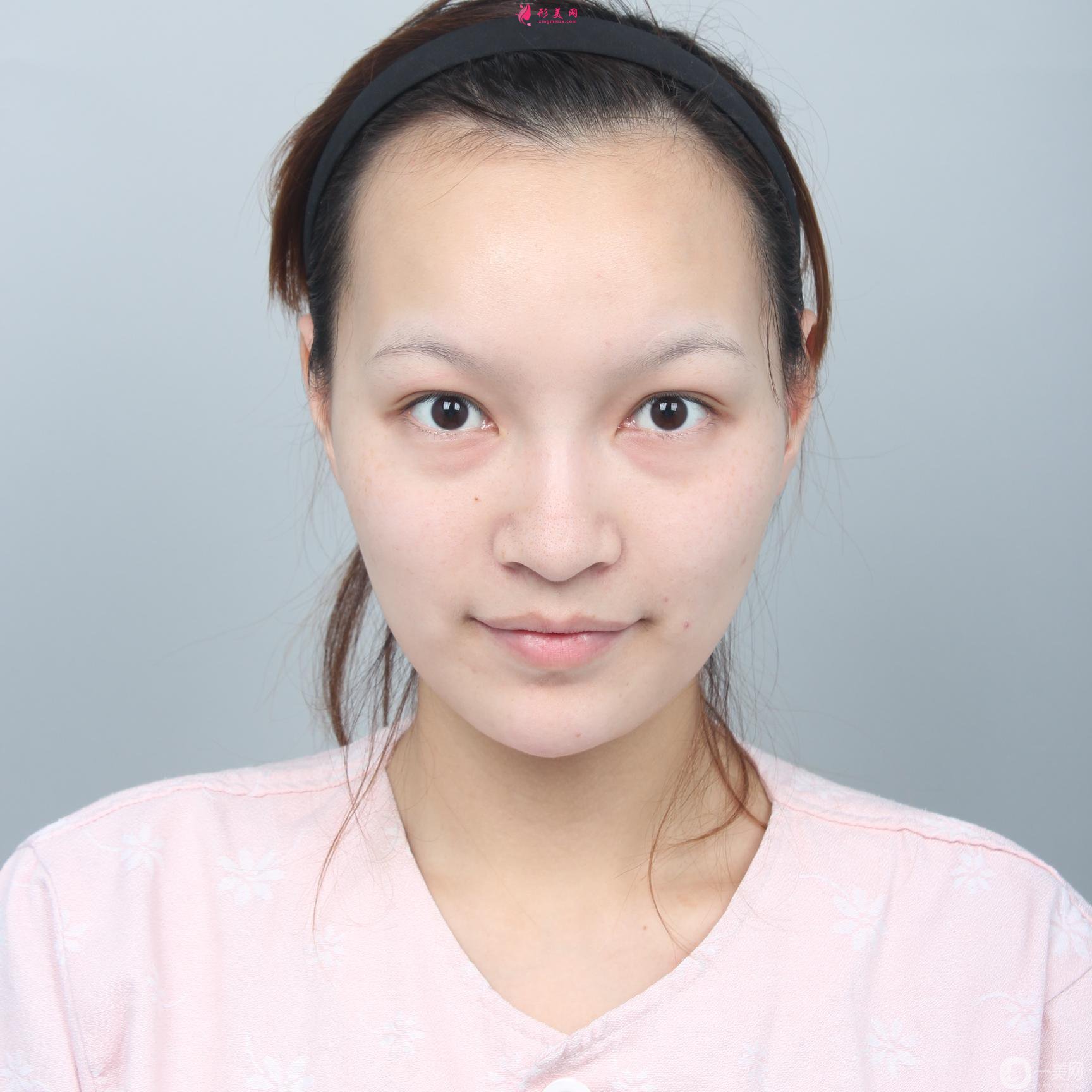 上海美聯(lián)臣下頜角整形恢復(fù)日記分享:術(shù)后500天了依然很完美~
