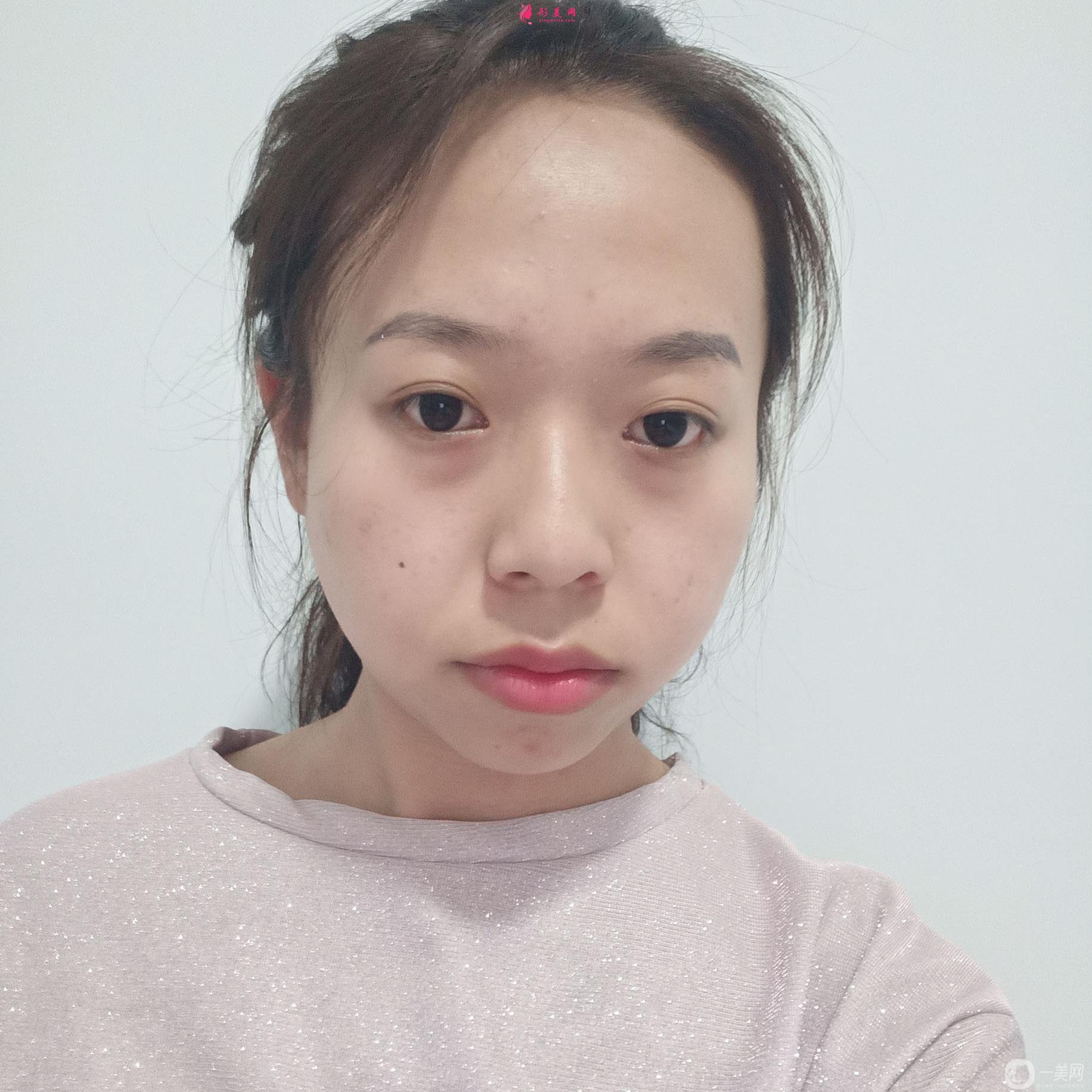 自體脂肪面部填充才一個(gè)月就讓我找回了自信!