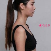 上海伊萊美醫(yī)療美容醫(yī)院隆胸怎么樣？術(shù)后案例分享