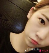 鄭州悅美整形美容醫(yī)院雙眼皮+隆胸前后對(duì)比圖分享