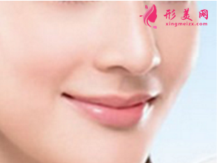 膨體隆鼻的優(yōu)勢是什么
