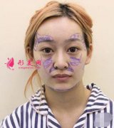 上海九院整形外科曹衛(wèi)剛脂肪面部填充案例分享，這個(gè)效果你i了嗎