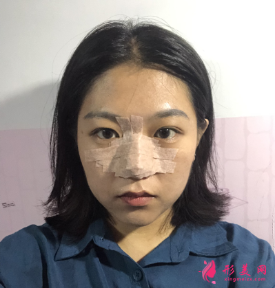 成都華美整形醫(yī)院隆鼻案例分享 40天前后對比圖