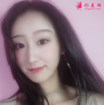 成都華美整形醫(yī)院隆鼻案例分享 40天前后對比圖