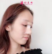 成都華美整形醫(yī)院隆鼻案例分享|40天前后對(duì)比圖