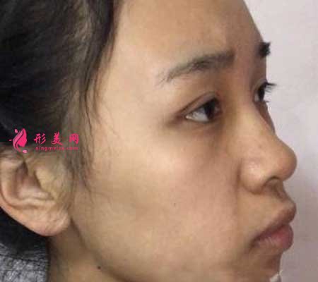 找南京鼓樓醫(yī)院譚謙醫(yī)生做了雙眼皮,我也是小仙女啦~