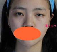 西安西京劉超華做雙眼皮怎么樣？40天恢復效果真的很棒
