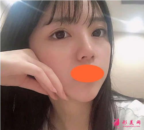 西安西京劉超華做雙眼皮怎么樣？40天恢復(fù)效果真的很棒