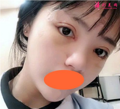 西安西京劉超華做雙眼皮怎么樣？40天恢復(fù)效果真的很棒